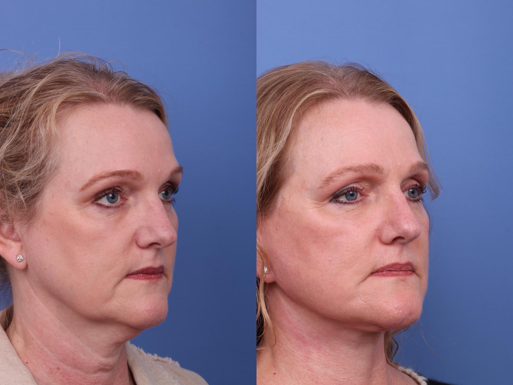 Before & After Facelift Case 608 Right Oblique View in Scottsdale, AZ