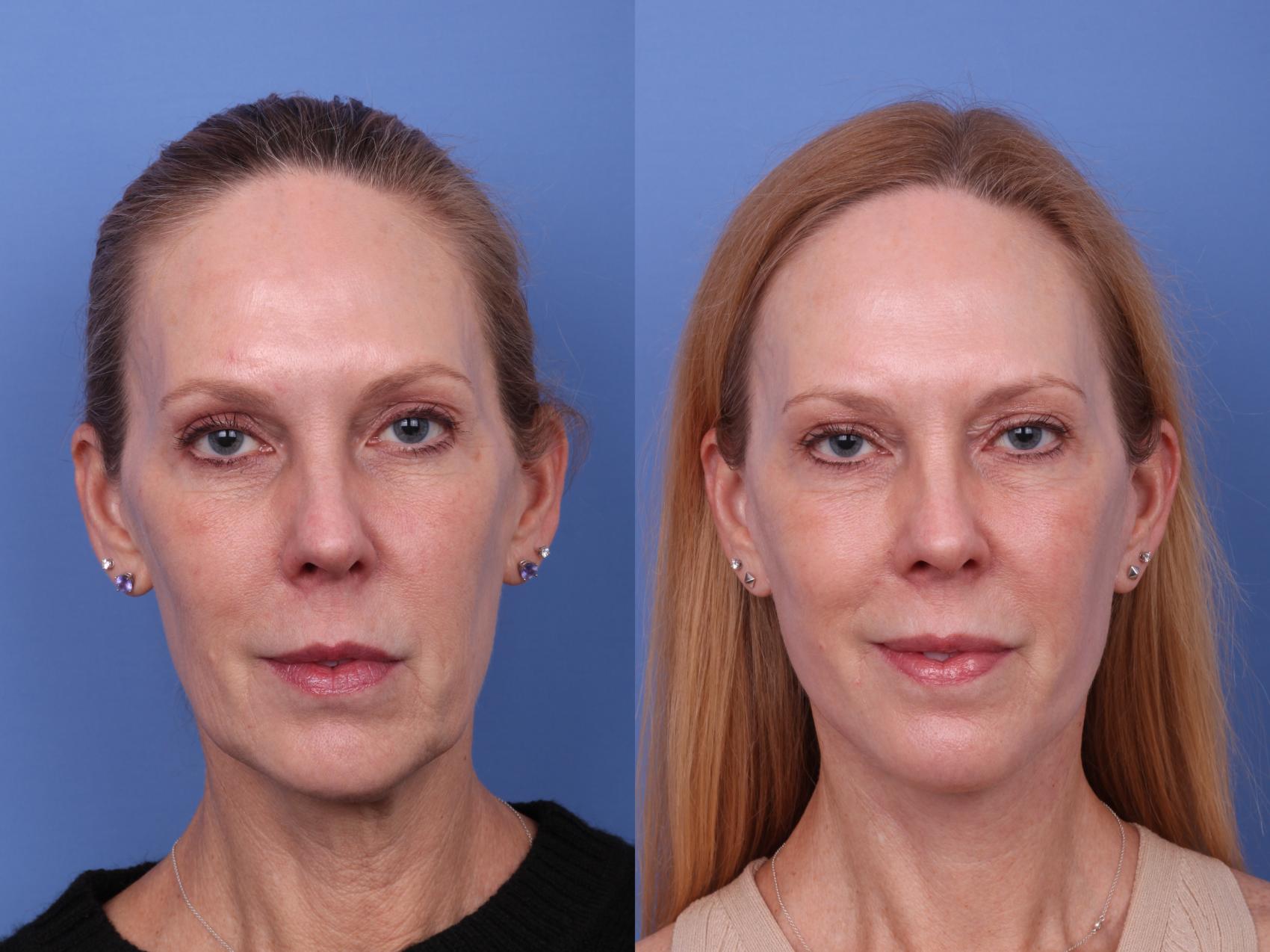Before & After Facelift Case 609 Front View in Scottsdale, AZ