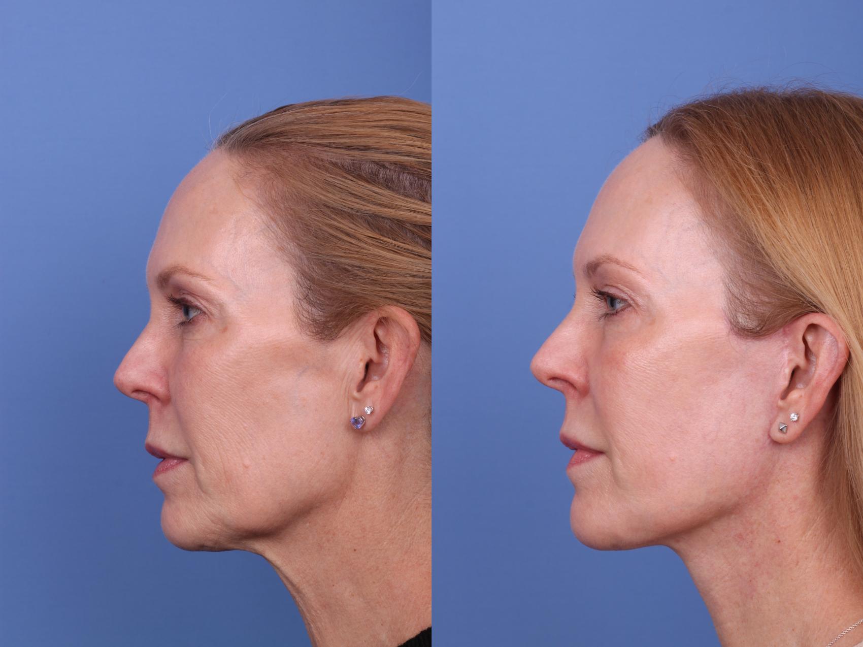 Before & After Facelift Case 609 Left Side View in Scottsdale, AZ