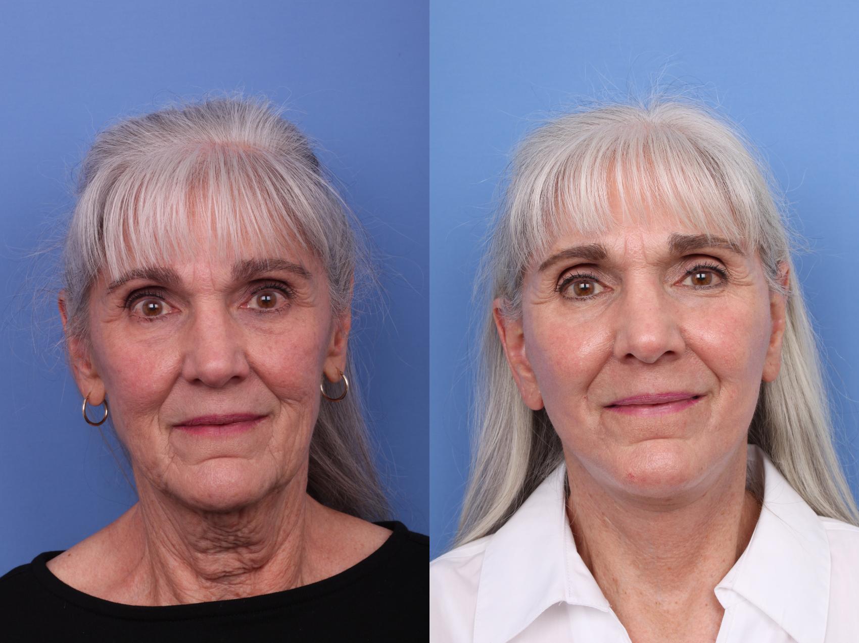 Before & After Facelift Case 611 Front View in Scottsdale, AZ