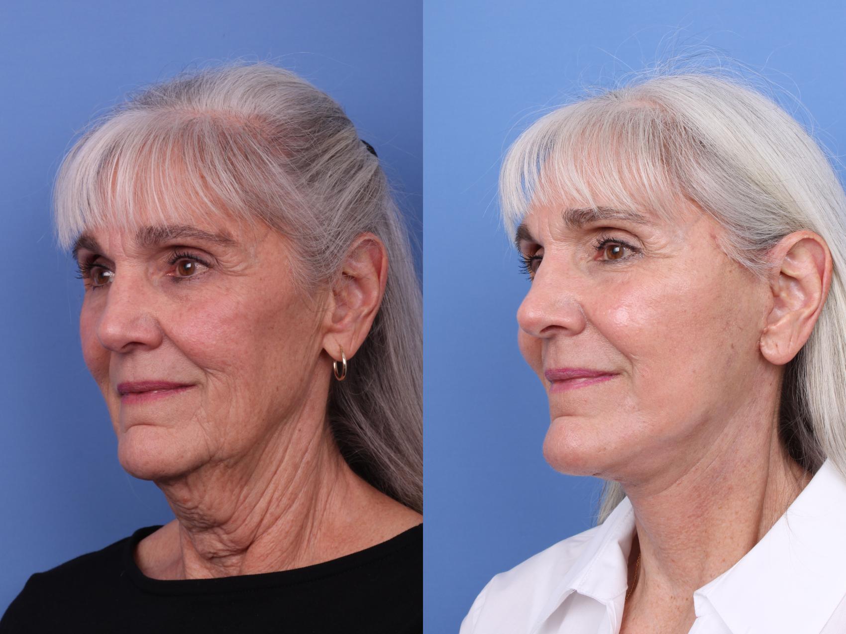Before & After Facelift Case 611 Left Oblique View in Scottsdale, AZ