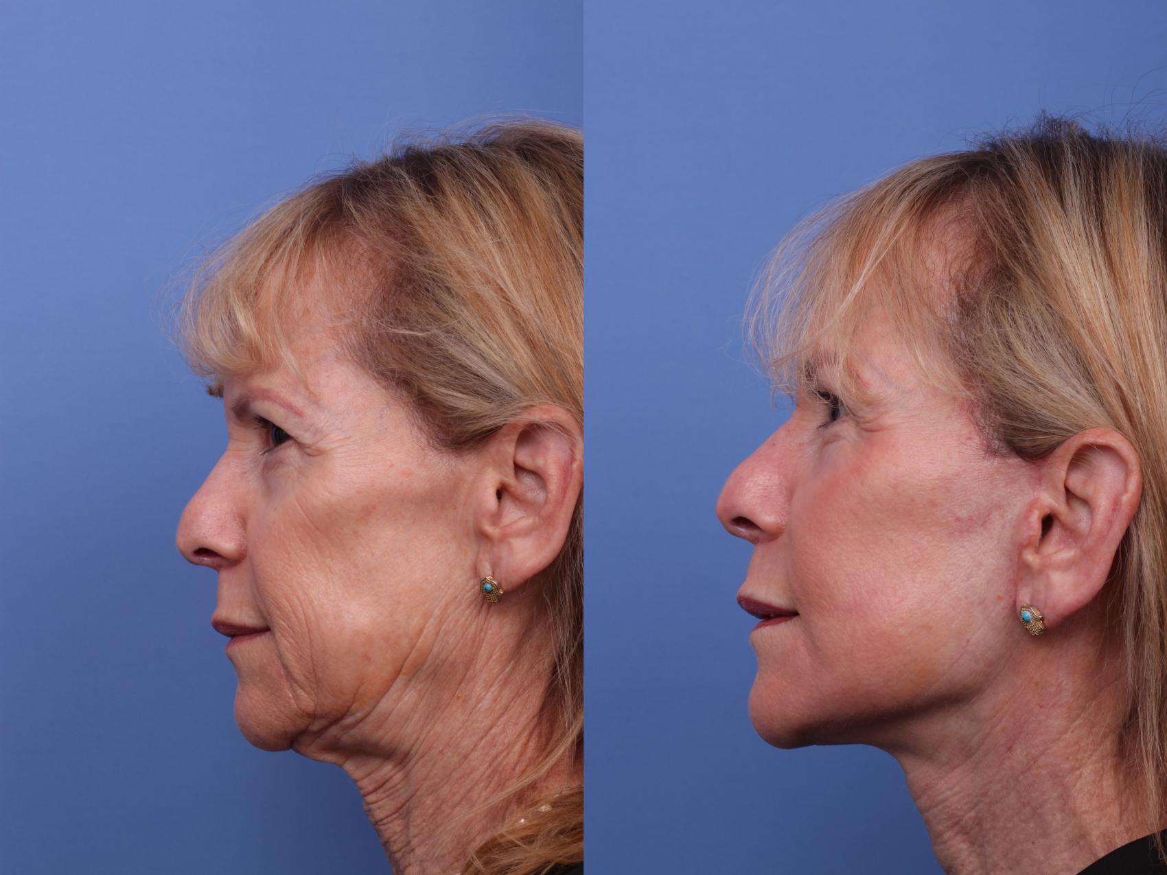 Before & After Facelift Case 614 Left Side View in Scottsdale, AZ
