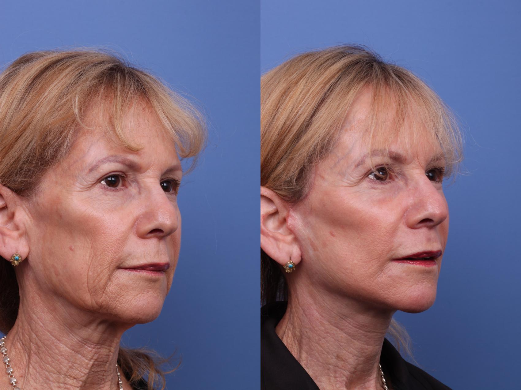 Before & After Facelift Case 614 Right Oblique View in Scottsdale, AZ