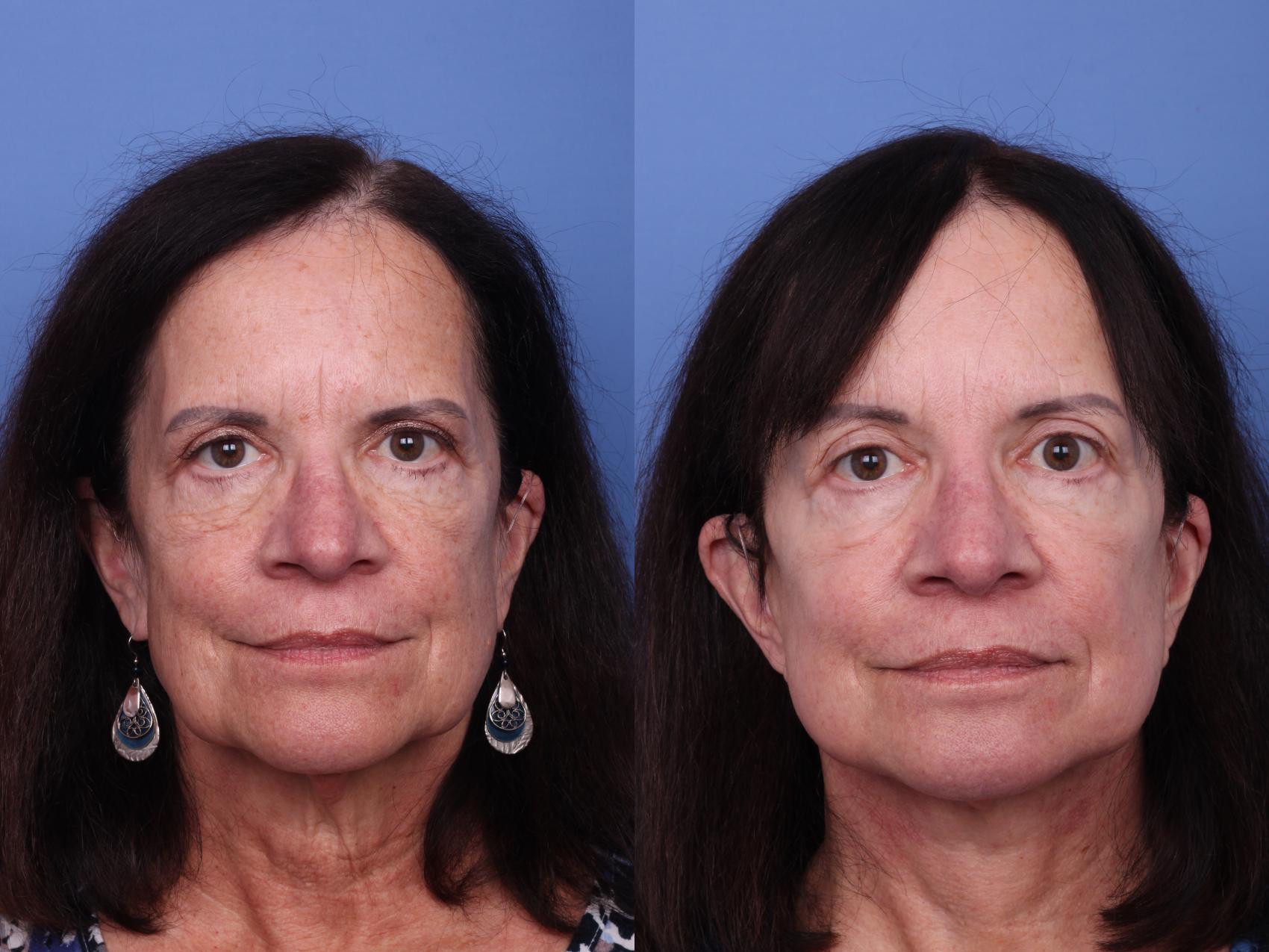 Before & After Facelift Case 615 Front View in Scottsdale, AZ