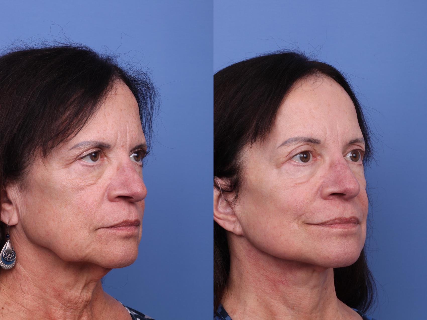 Before & After Facelift Case 615 Right Oblique View in Scottsdale, AZ