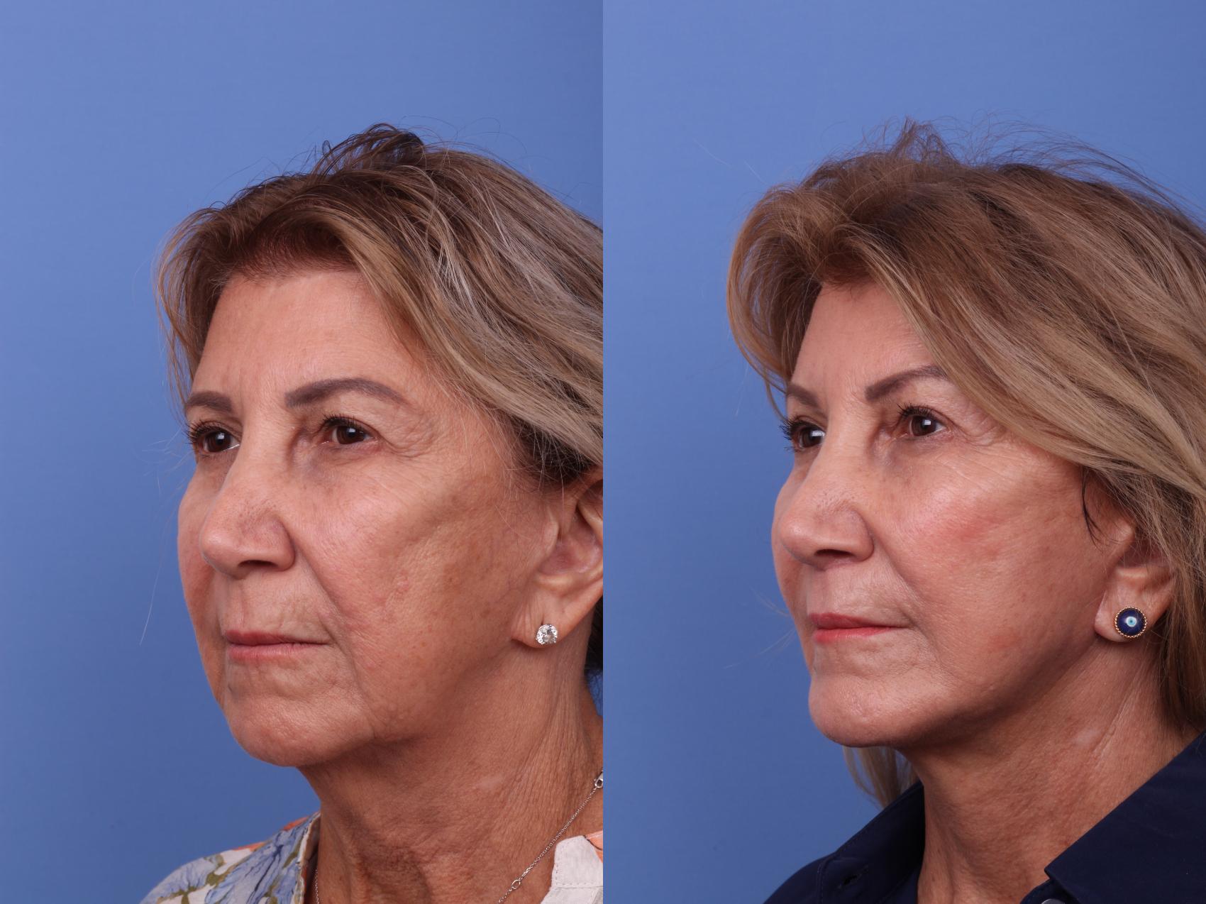 Before & After Chin Implant Case 618 Left Oblique View in Scottsdale, AZ