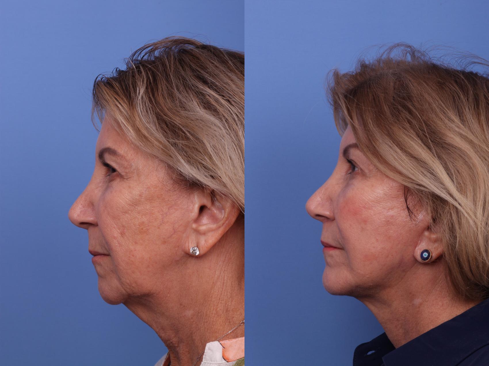 Before & After Chin Implant Case 618 Left Side View in Scottsdale, AZ