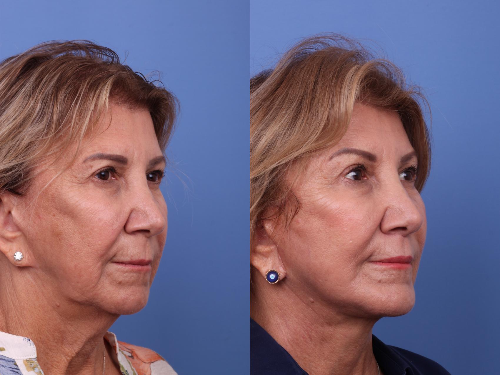 Before & After Chin Implant Case 618 Right Oblique View in Scottsdale, AZ