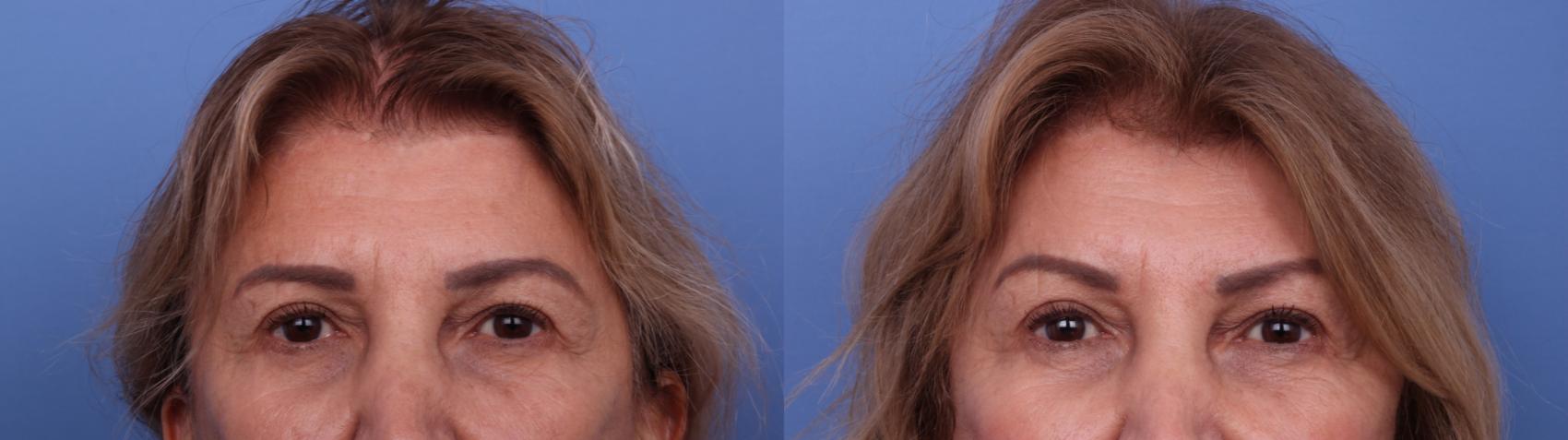 Before & After Chin Implant Case 618 Zoom Brow View in Scottsdale, AZ