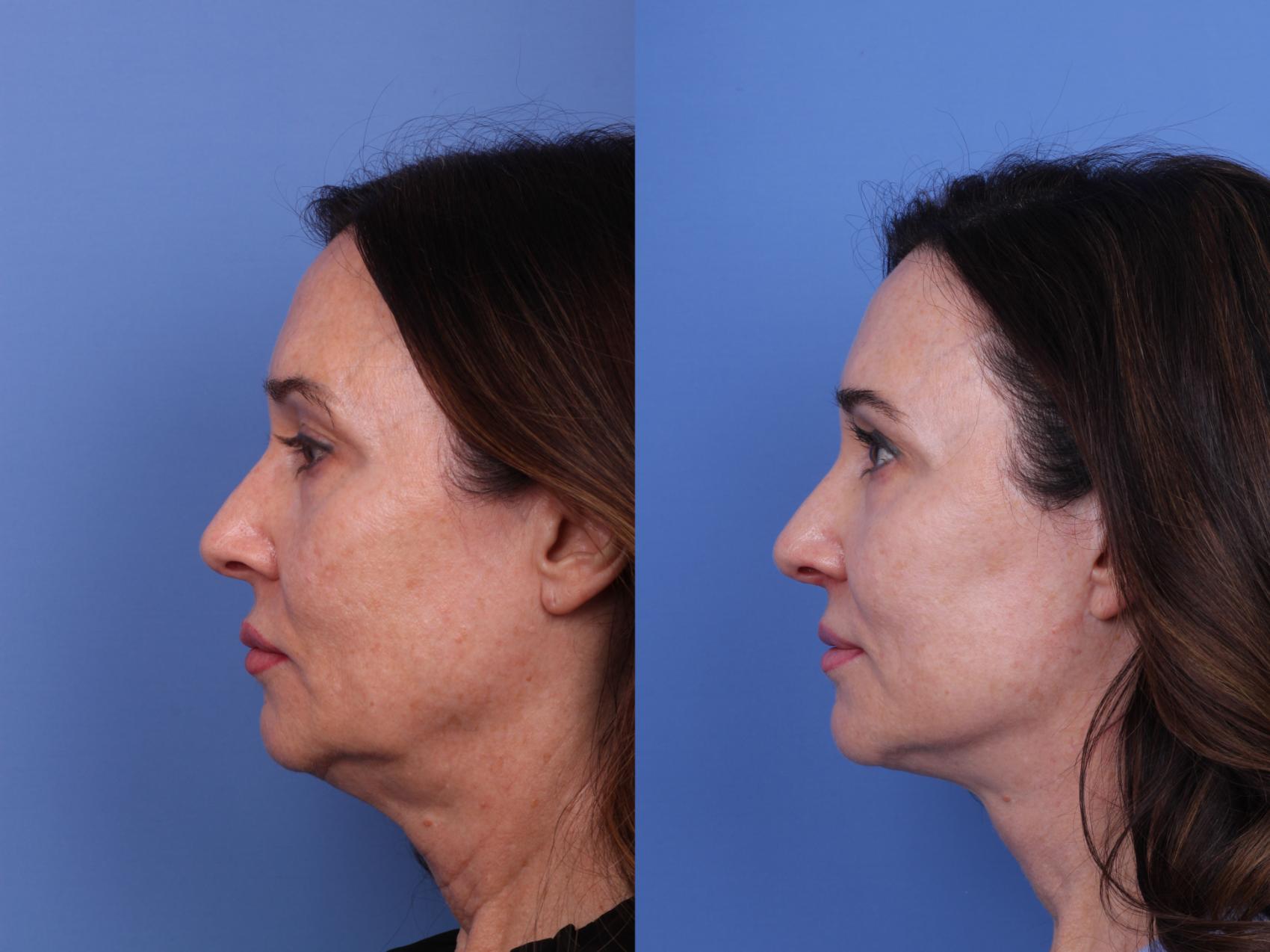 Before & After Facelift Case 620 Left Side View in Scottsdale, AZ