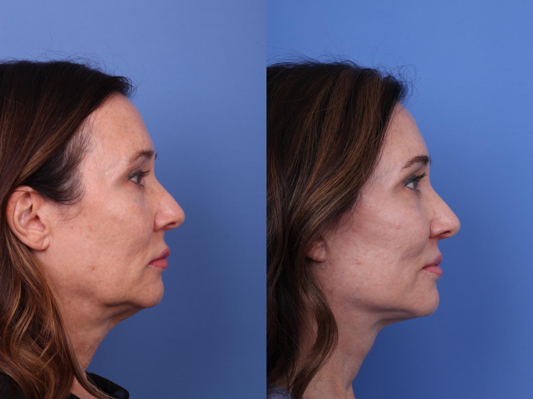 Before & After Facelift Case 620 Right Side View in Scottsdale, AZ