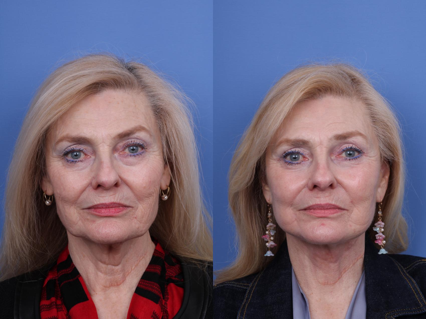 Before & After Blepharoplasty Case 626 Front View in Scottsdale, AZ