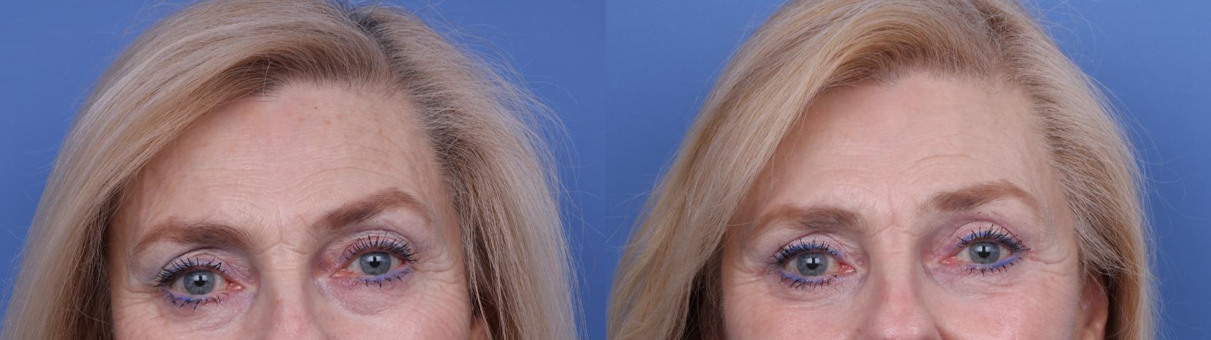 Before & After Blepharoplasty Case 626 Zoom Bleph View in Scottsdale, AZ