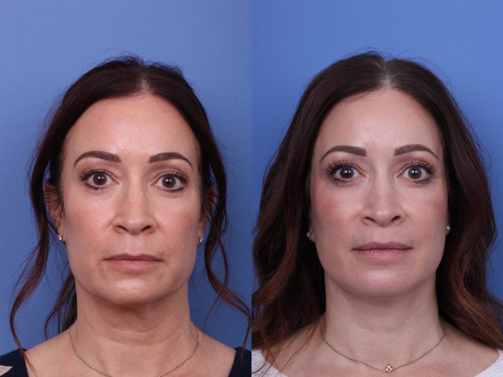 Before & After Facelift Case 627 Front View in Scottsdale, AZ