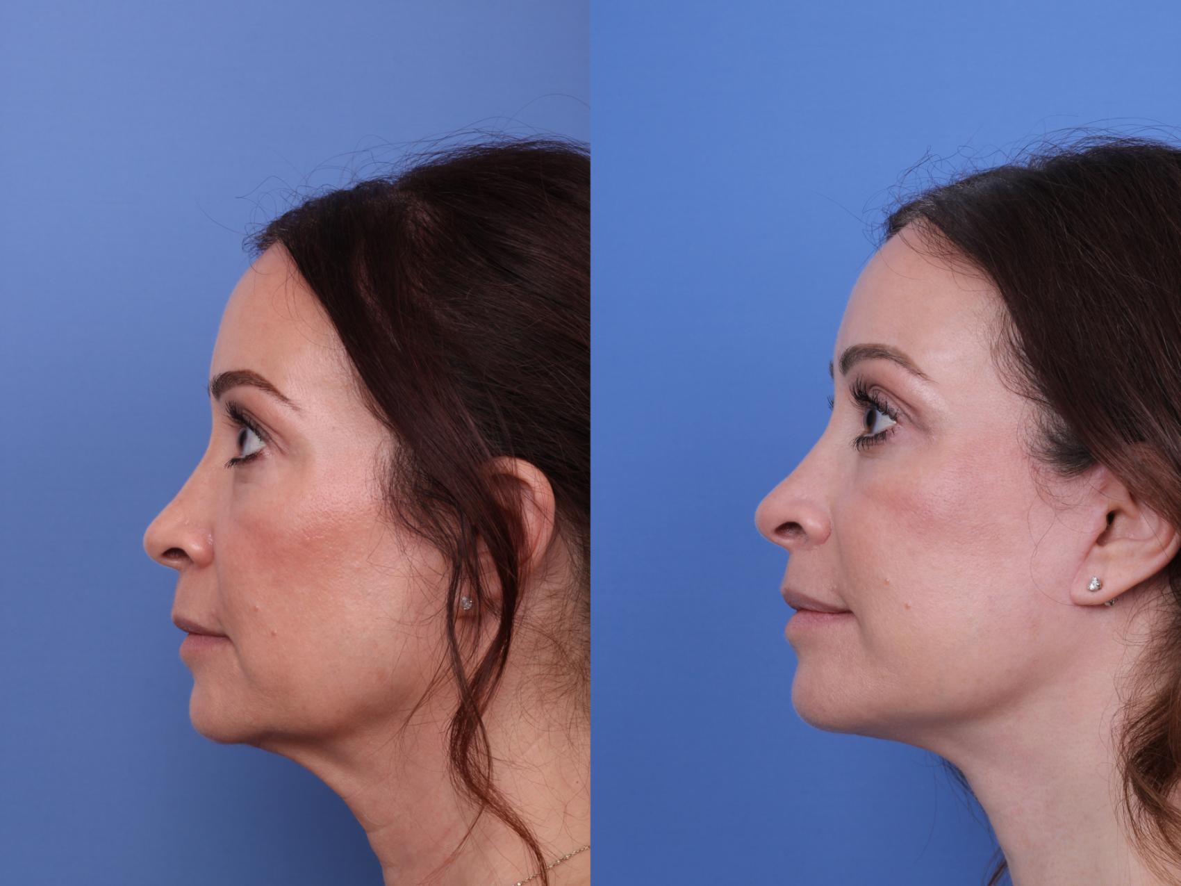 Before & After Facelift Case 627 Left Side View in Scottsdale, AZ