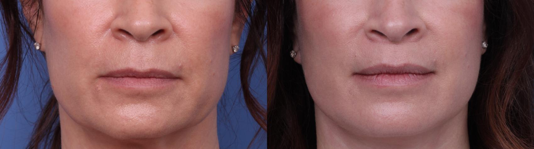 Before & After Facelift Case 627 Lips View in Scottsdale, AZ