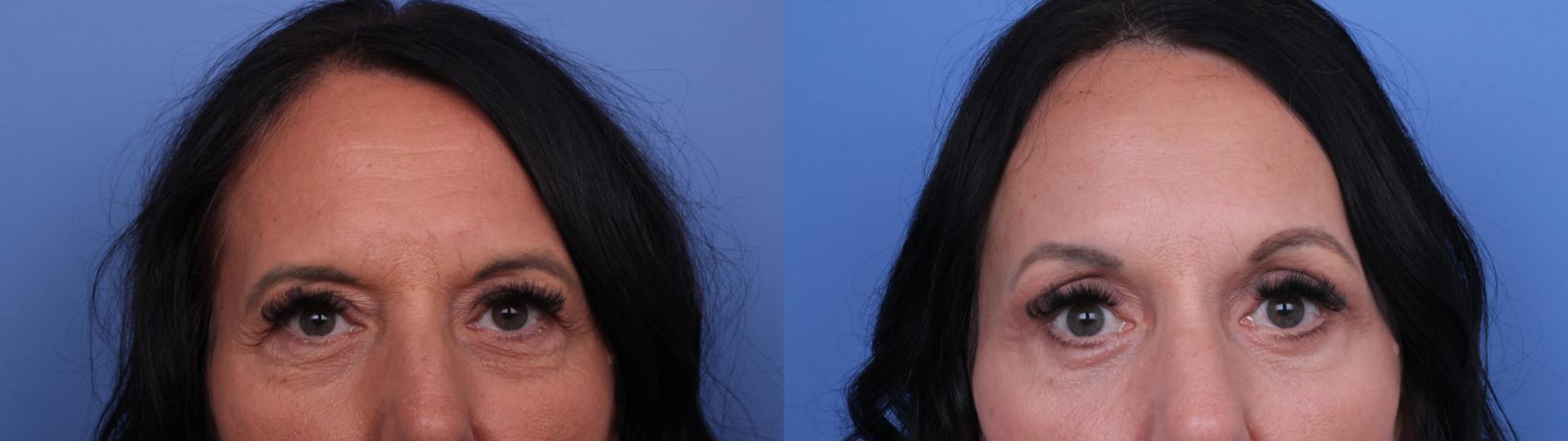 Before & After Blepharoplasty Case 628 Zoom Bleph View in Scottsdale, AZ