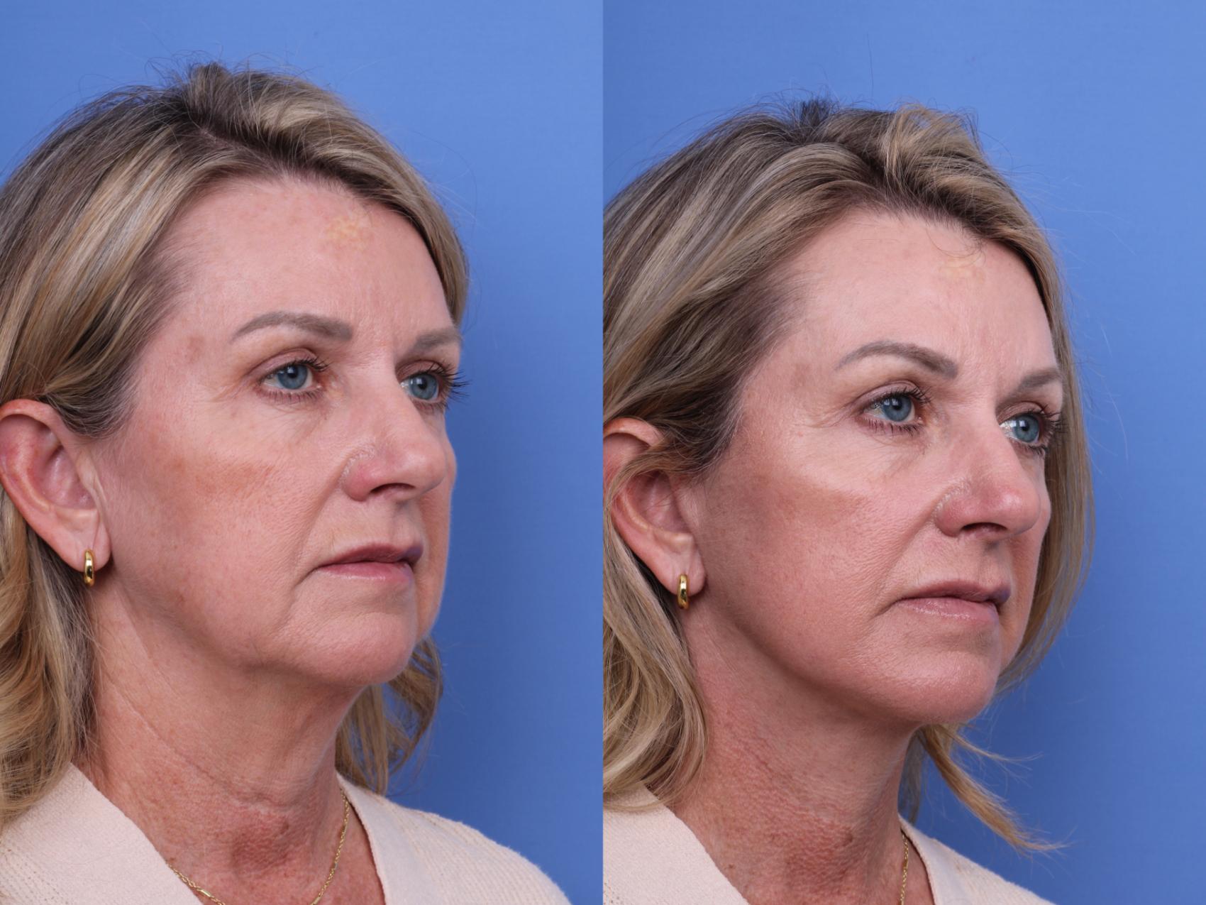 Before & After Facelift Case 631 Right Oblique View in Scottsdale, AZ