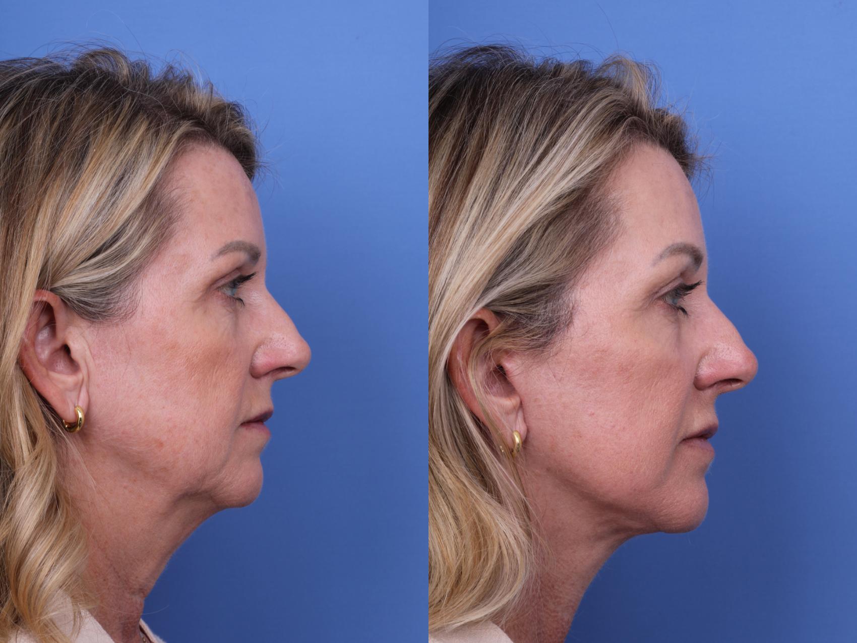 Before & After Facelift Case 631 Right Side View in Scottsdale, AZ