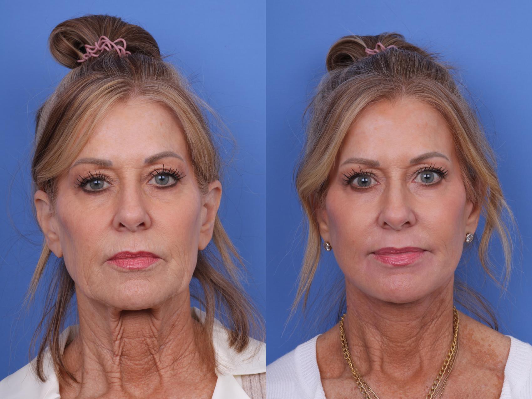 Before & After Facelift Case 632 Front View in Scottsdale, AZ