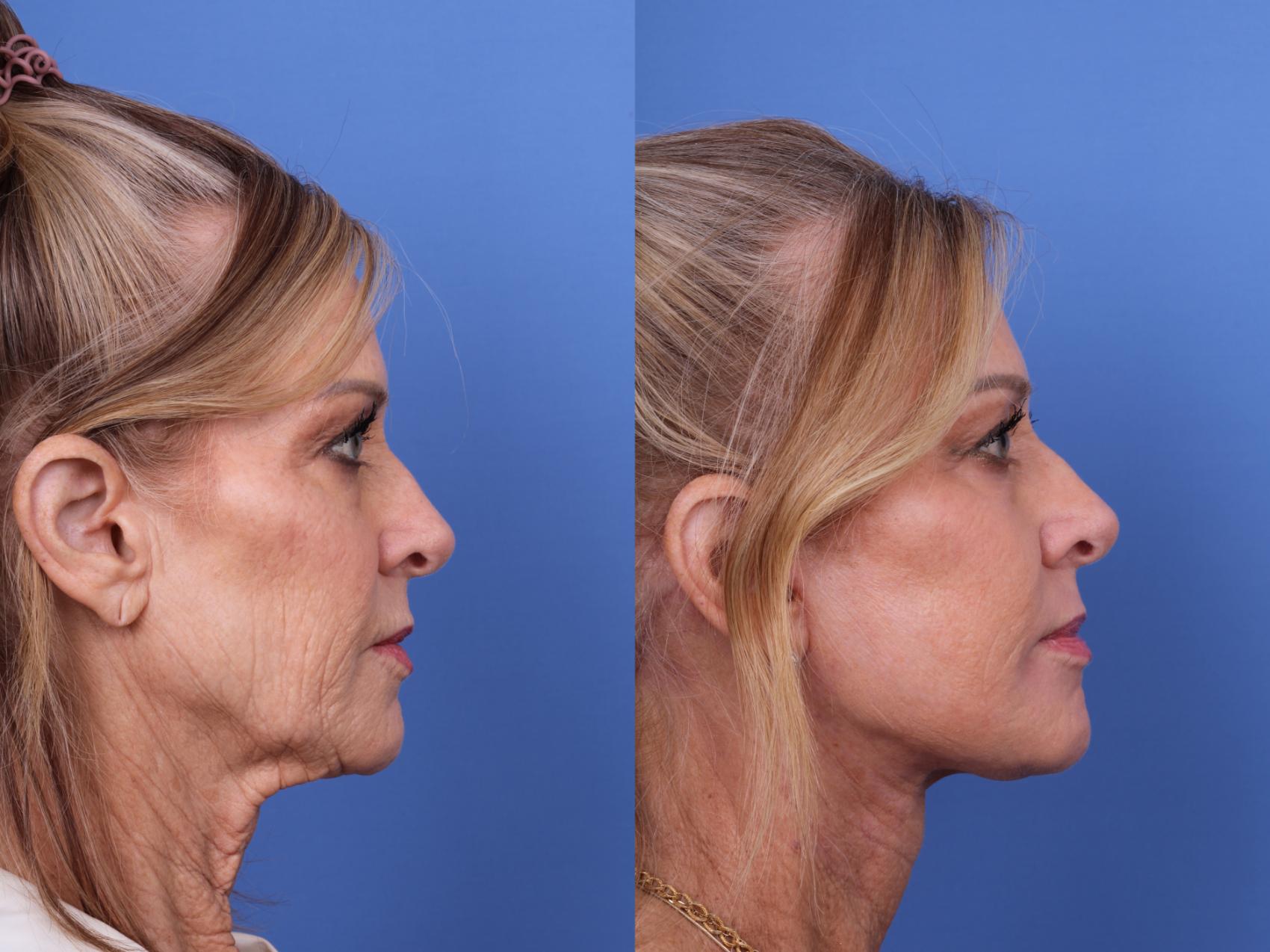 Before & After Facelift Case 632 Right Side View in Scottsdale, AZ