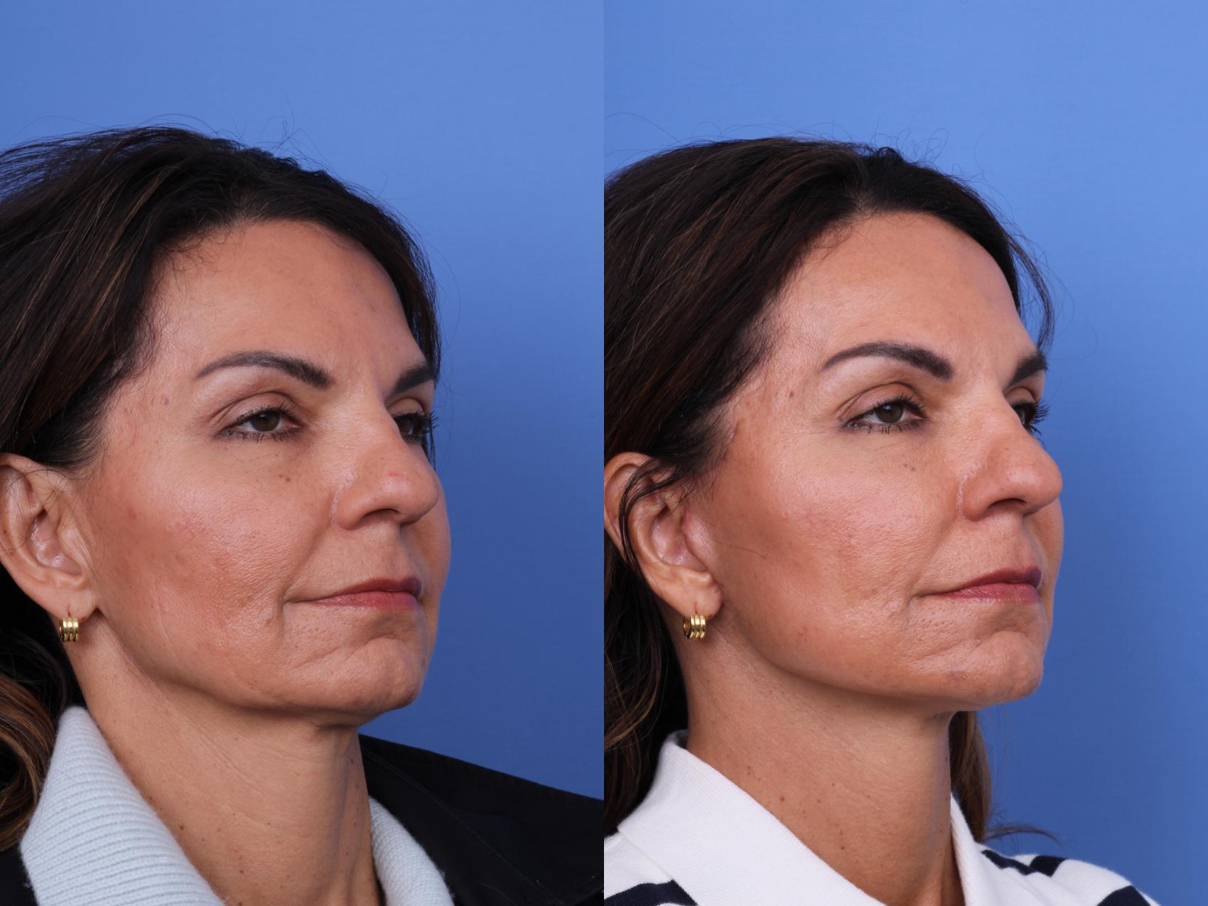 Before & After Facelift Case 635 Right Oblique View in Scottsdale, AZ
