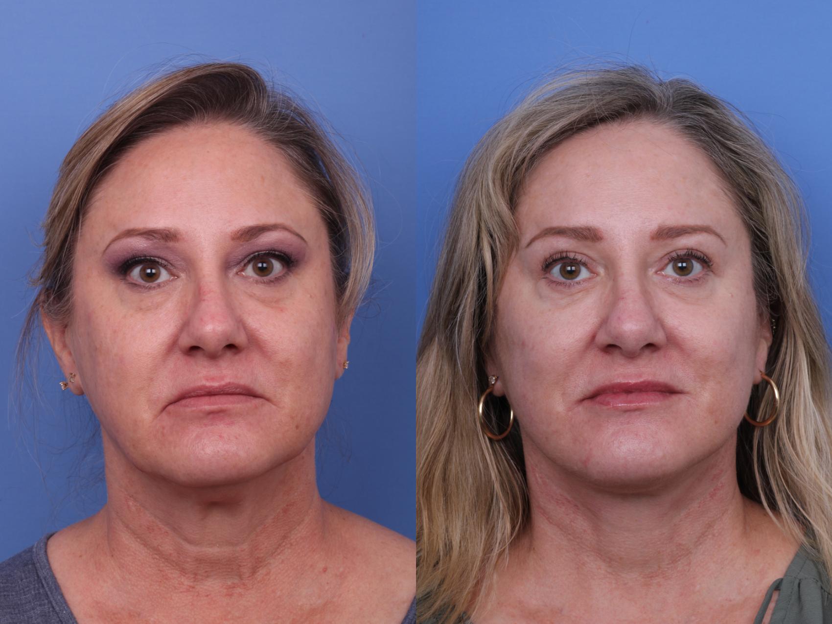 Before & After Facelift Case 639 Front View in Scottsdale, AZ