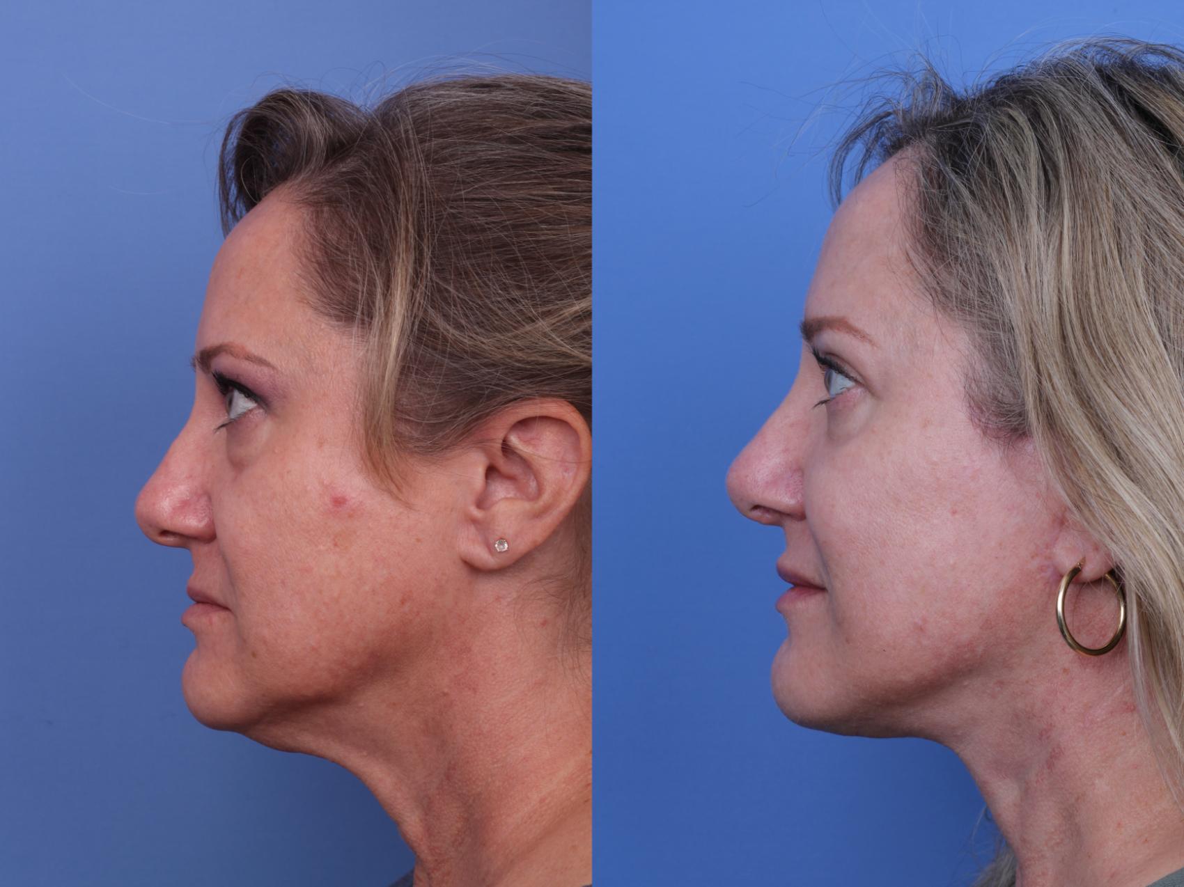 Before & After Facelift Case 639 Left Side View in Scottsdale, AZ