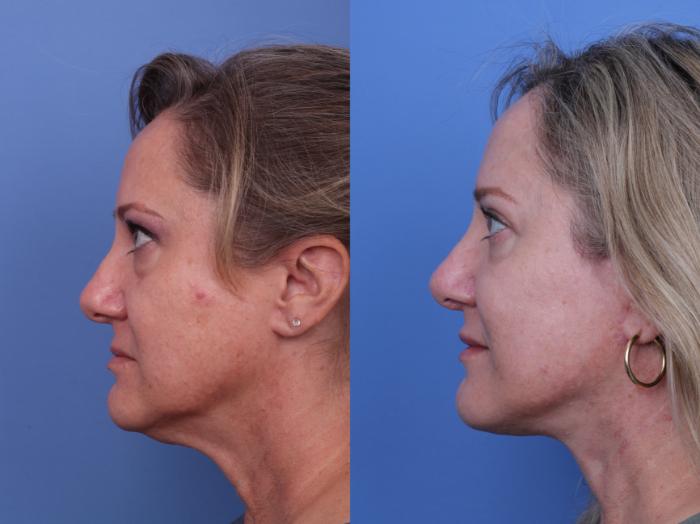 Facelift Before & After Photo | Scottsdale & Phoenix, AZ | Hobgood Facial Plastic Surgery: Todd Hobgood, MD