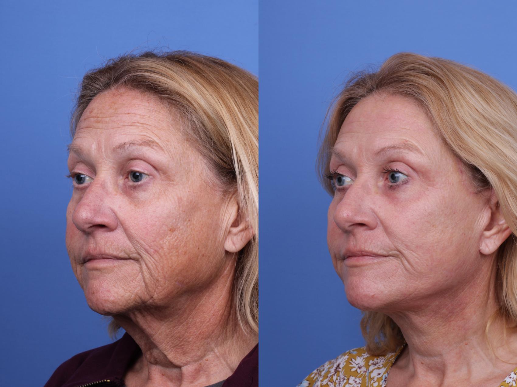 Before & After Facelift Case 641 Left Oblique View in Scottsdale, AZ