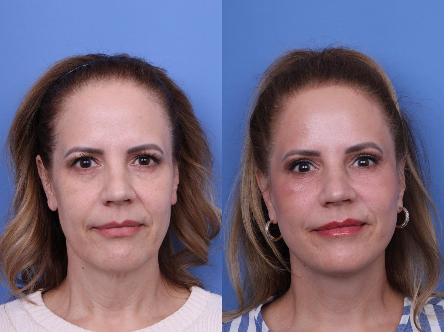 Before & After Facelift Case 642 Front View in Scottsdale, AZ