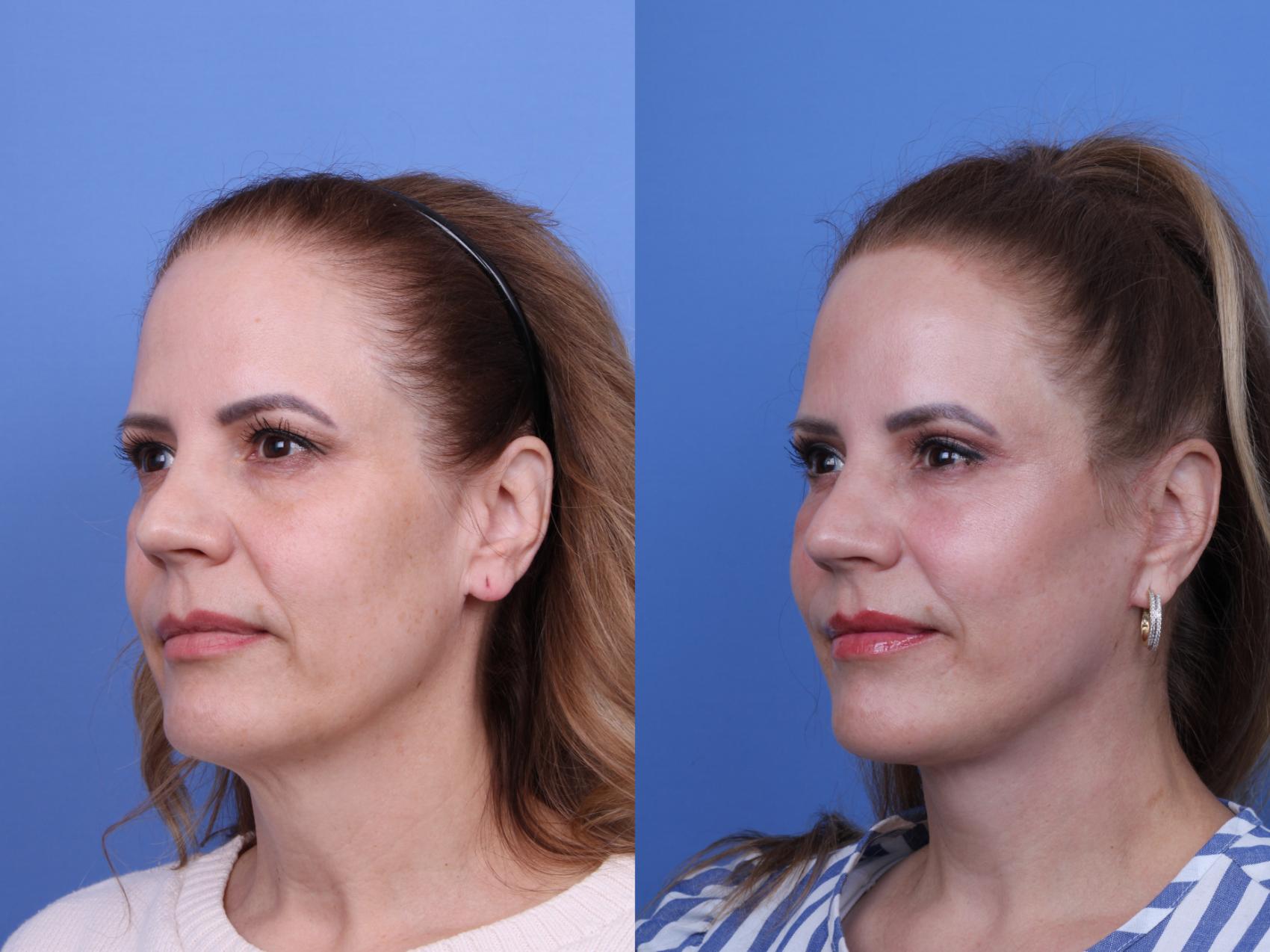 Before & After Facelift Case 642 Left Oblique View in Scottsdale, AZ