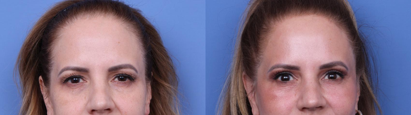 Before & After Facelift Case 642 Zoom Bleph View in Scottsdale, AZ