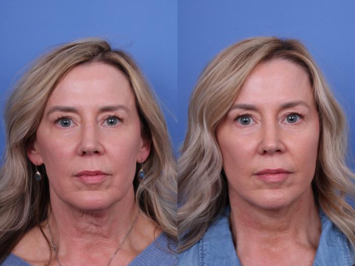 Facelift Before & After Photo | Scottsdale & Phoenix, AZ | Hobgood Facial Plastic Surgery: Todd Hobgood, MD