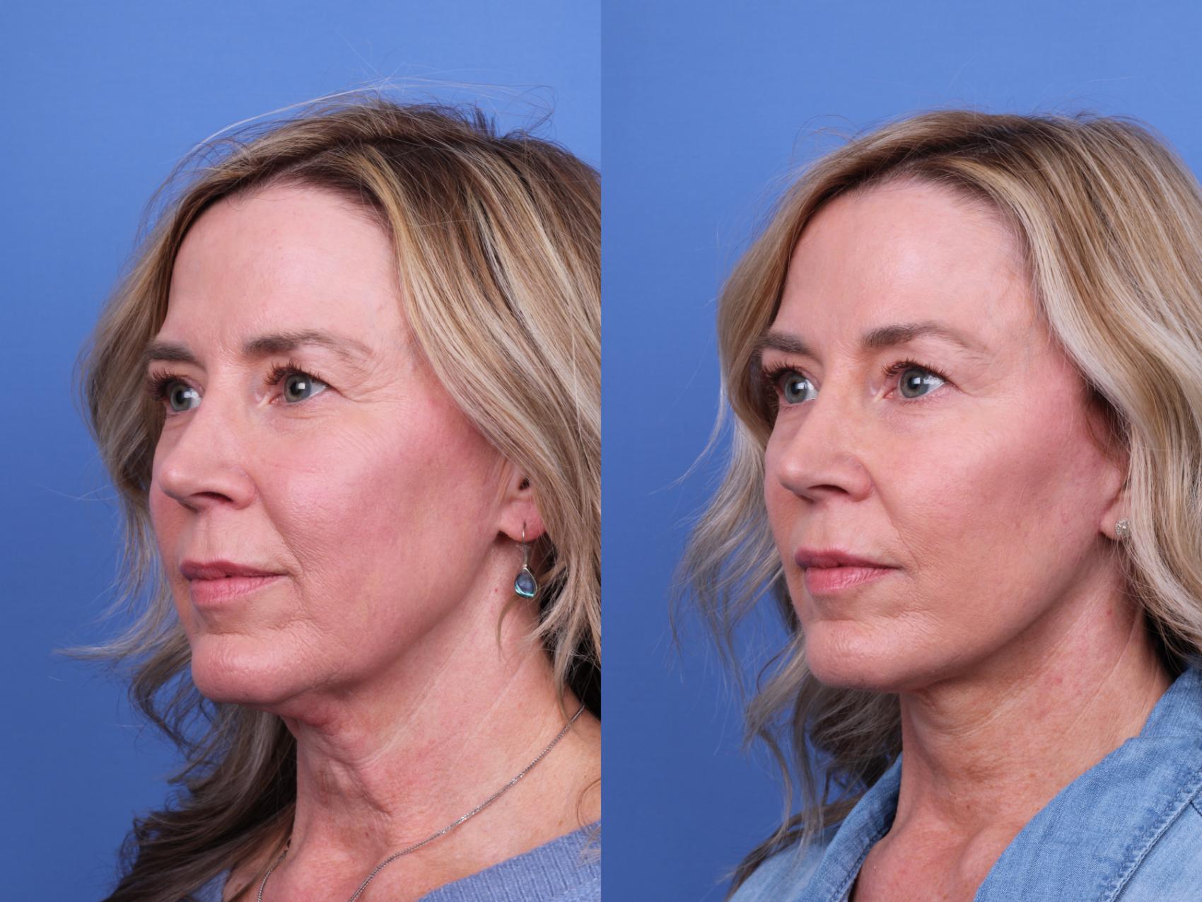 Before & After Facelift Case 645 Left Oblique View in Scottsdale, AZ