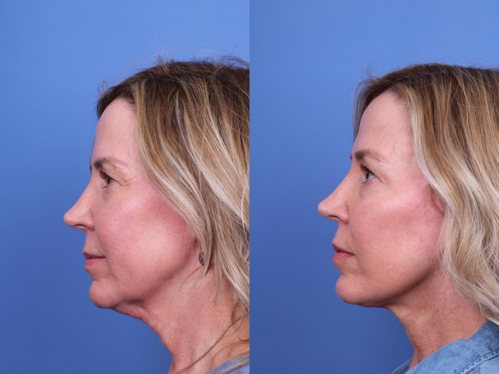 Before & After Facelift Case 645 Left Side View in Scottsdale, AZ