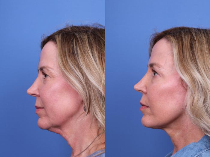 Facelift Before & After Photo | Scottsdale & Phoenix, AZ | Hobgood Facial Plastic Surgery: Todd Hobgood, MD