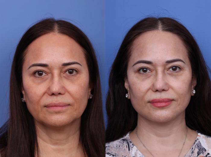 Facelift Before & After Photo | Scottsdale & Phoenix, AZ | Hobgood Facial Plastic Surgery: Todd Hobgood, MD