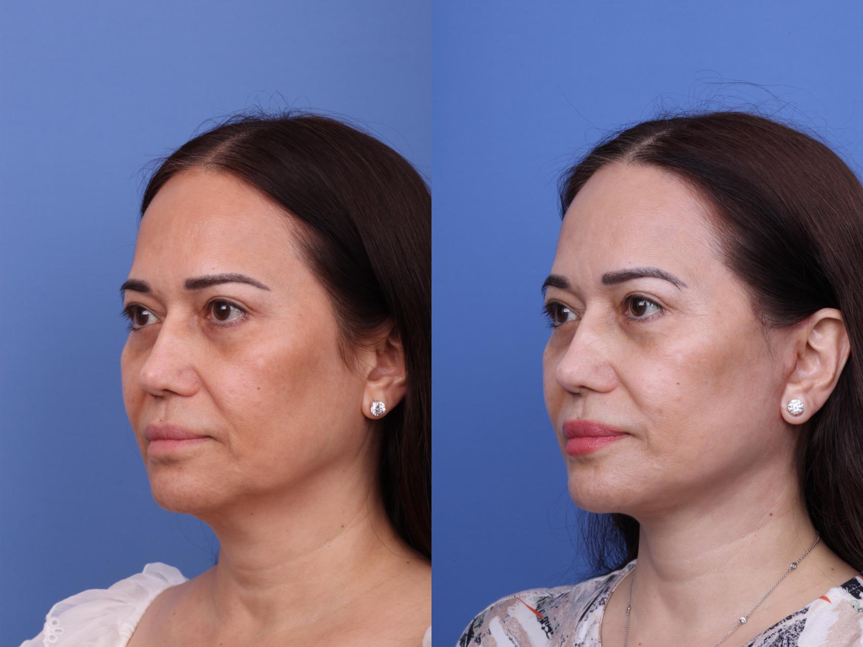 Before & After Facelift Case 649 Left Oblique View in Scottsdale, AZ