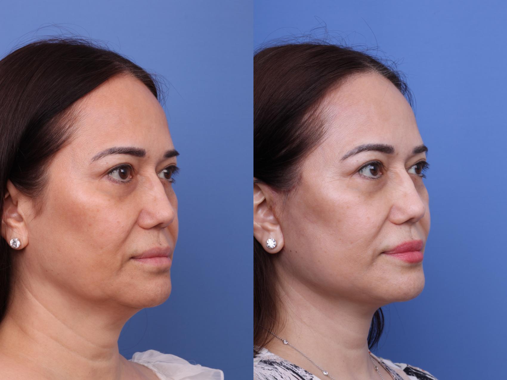 Before & After Facelift Case 649 Right Oblique View in Scottsdale, AZ