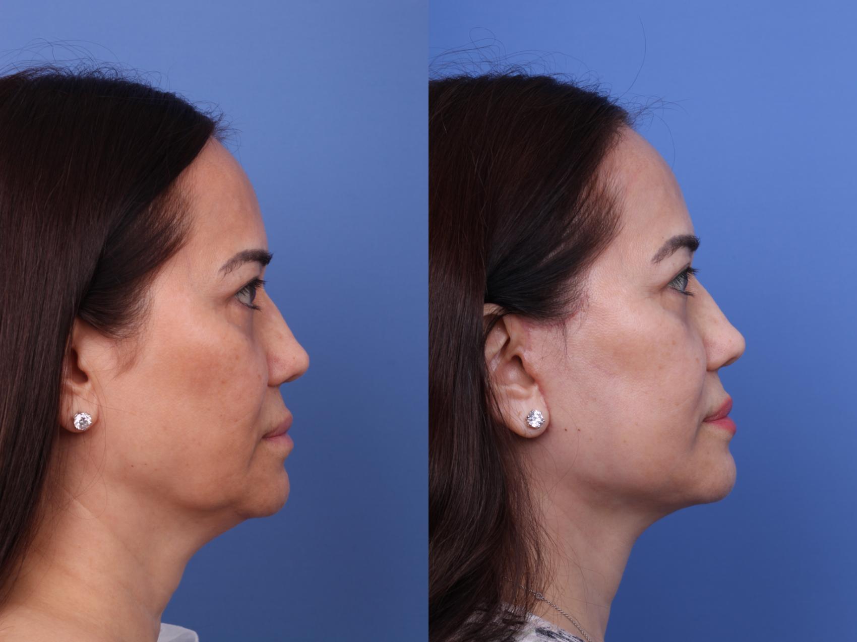 Before & After Facelift Case 649 Right Side View in Scottsdale, AZ