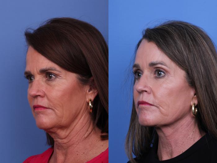 Facelift Before & After Photo | Scottsdale & Phoenix, AZ | Hobgood Facial Plastic Surgery: Todd Hobgood, MD