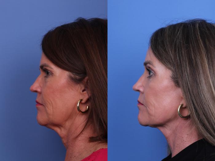 Facelift Before & After Photo | Scottsdale & Phoenix, AZ | Hobgood Facial Plastic Surgery: Todd Hobgood, MD