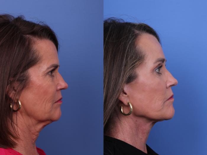 Facelift Before & After Photo | Scottsdale & Phoenix, AZ | Hobgood Facial Plastic Surgery: Todd Hobgood, MD