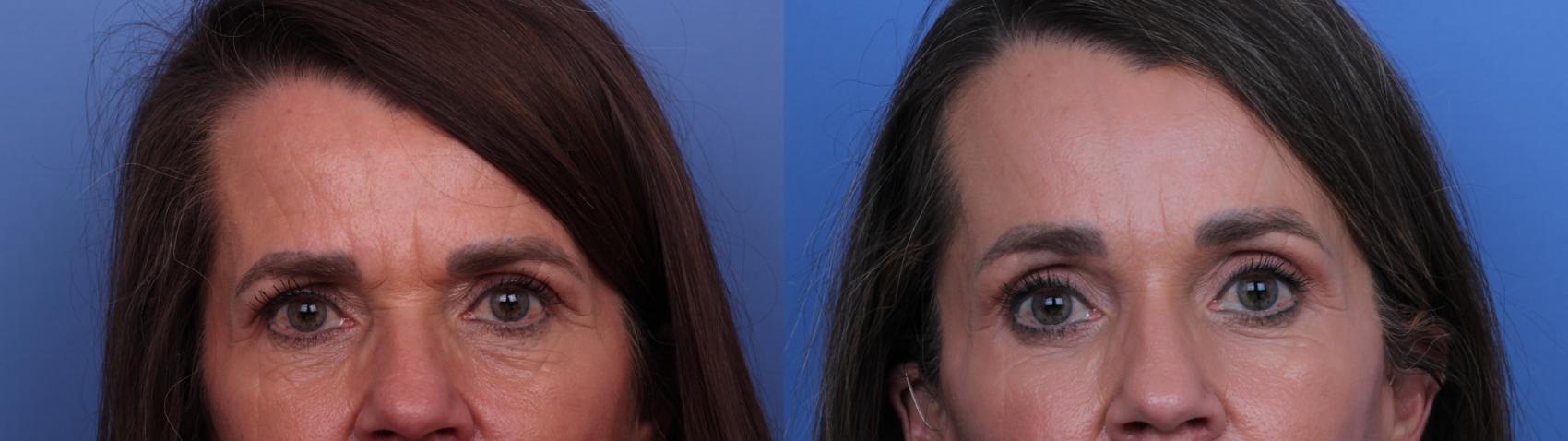 Before & After Facelift Case 650 Zoom Bleph View in Scottsdale, AZ
