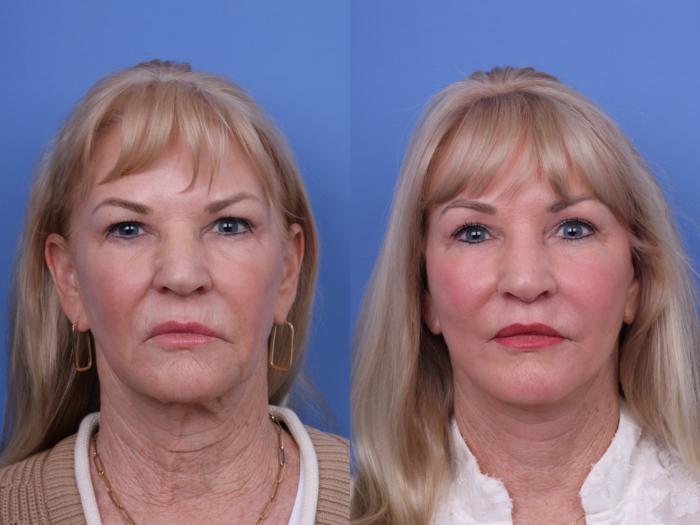 Facelift Before & After Photo | Scottsdale & Phoenix, AZ | Hobgood Facial Plastic Surgery: Todd Hobgood, MD