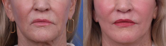 Facelift Before & After Photo | Scottsdale & Phoenix, AZ | Hobgood Facial Plastic Surgery: Todd Hobgood, MD