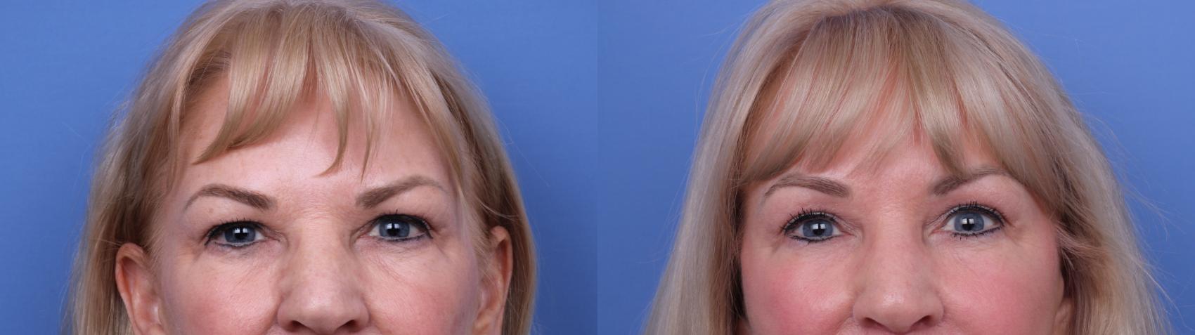 Before & After Facelift Case 651 Zoom Brow View in Scottsdale, AZ
