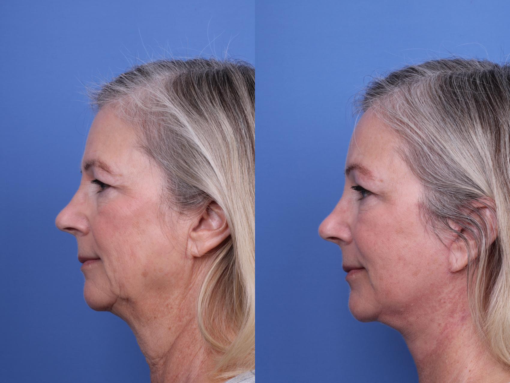 Facelift Before and After Pictures Case 654 | Scottsdale, AZ