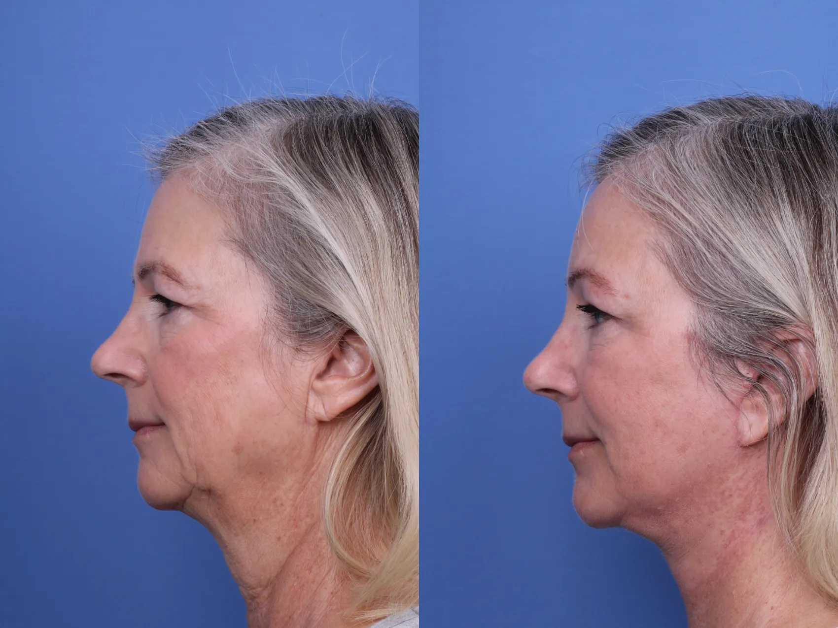 Facelift Before and After Pictures Case 654 | Scottsdale, AZ